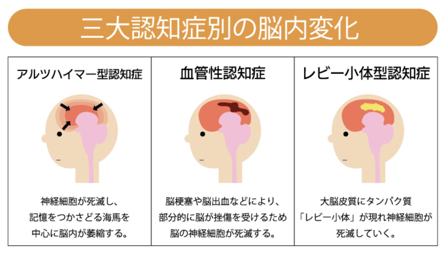 認知 症 の 原因