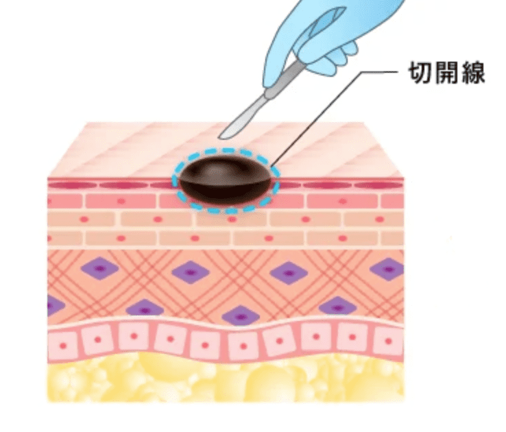 ほくろ除去　くりぬき法