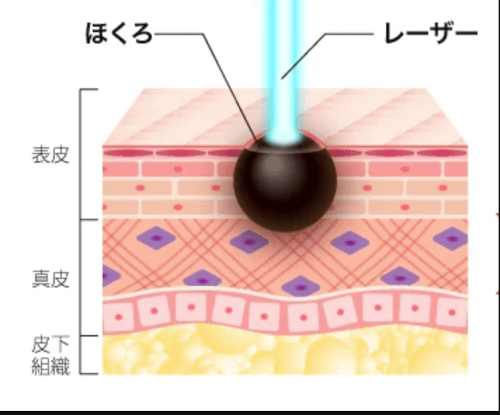 ほくろ除去レーザー除去法