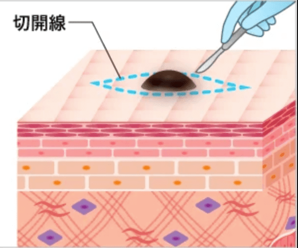 ほくろ除去切開法