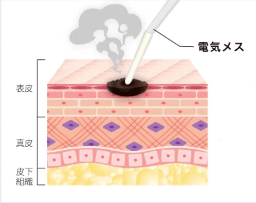 ほくろ除去　電気メス法