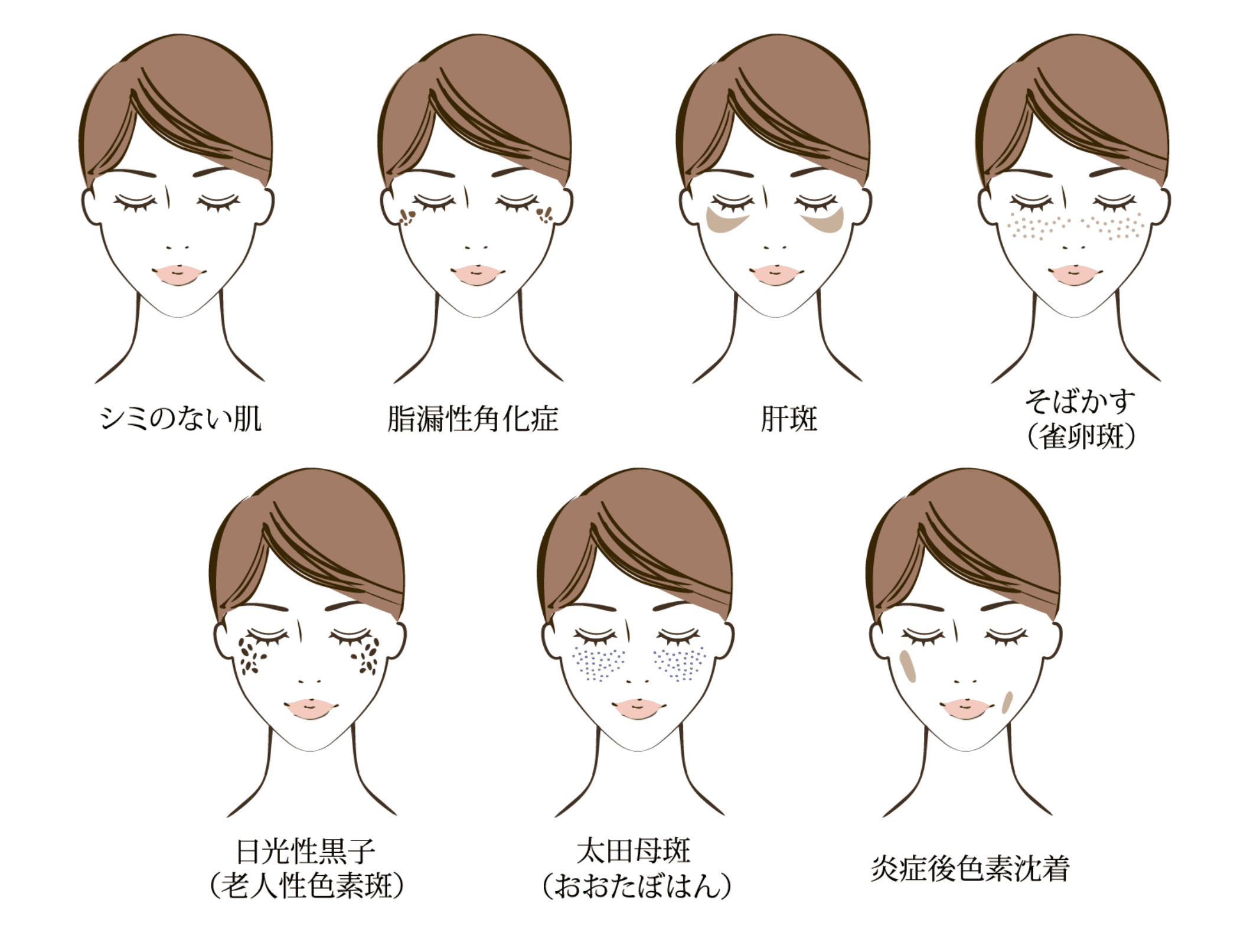 シミの種類