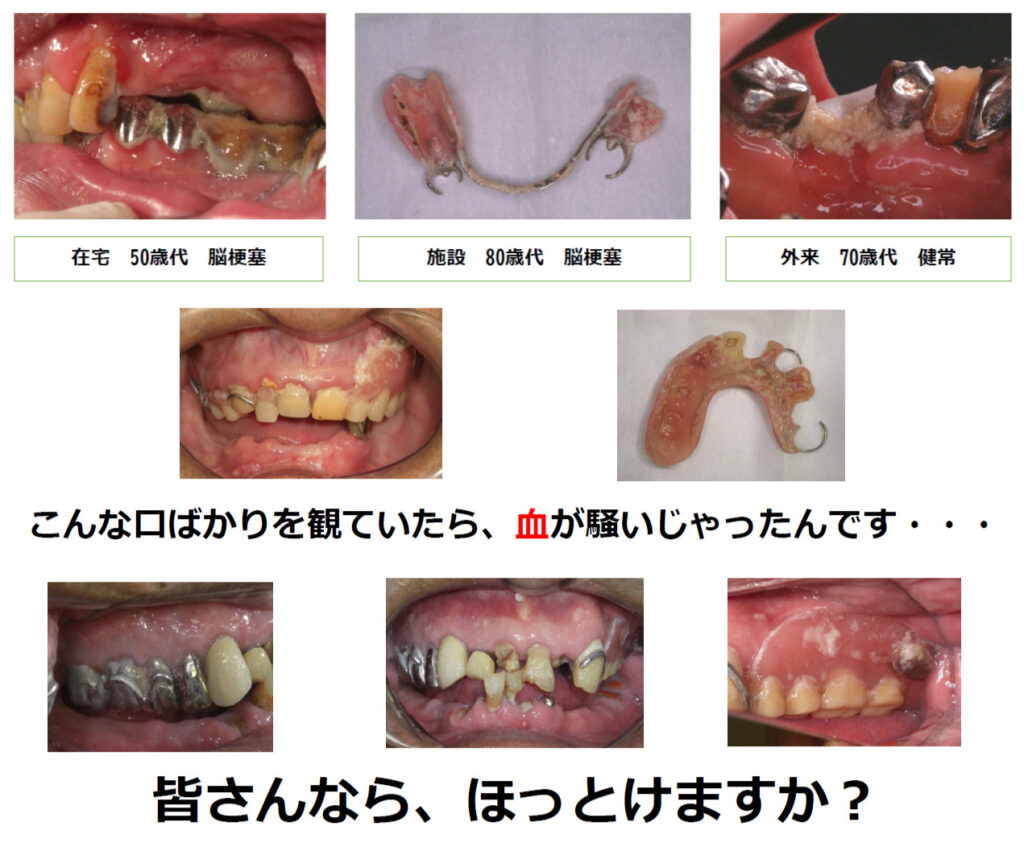 高齢者の口腔内写真