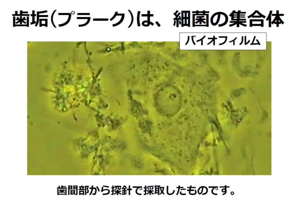 歯垢（プラーク）は細菌の集合体