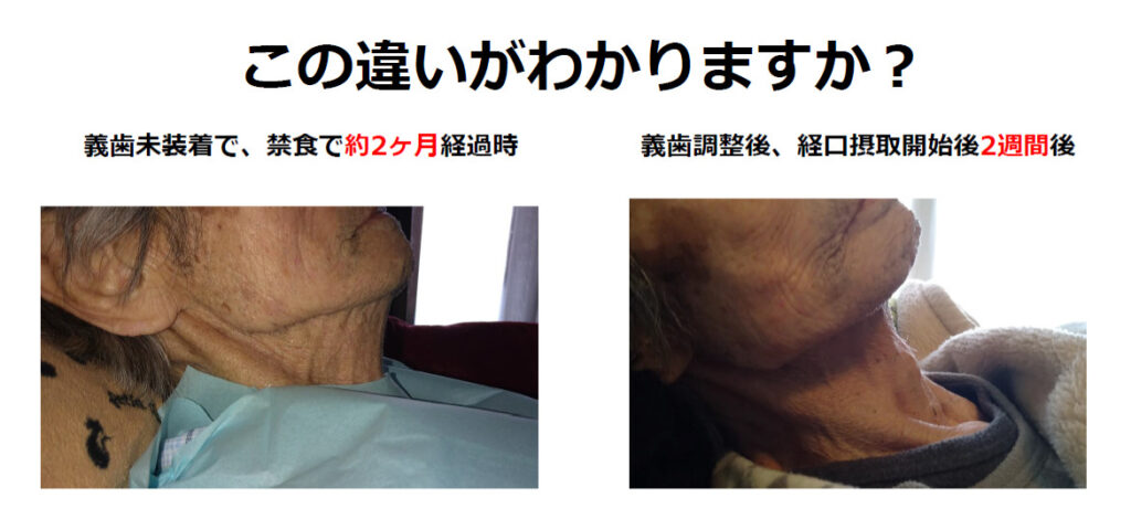 義歯調整後の表情の違い