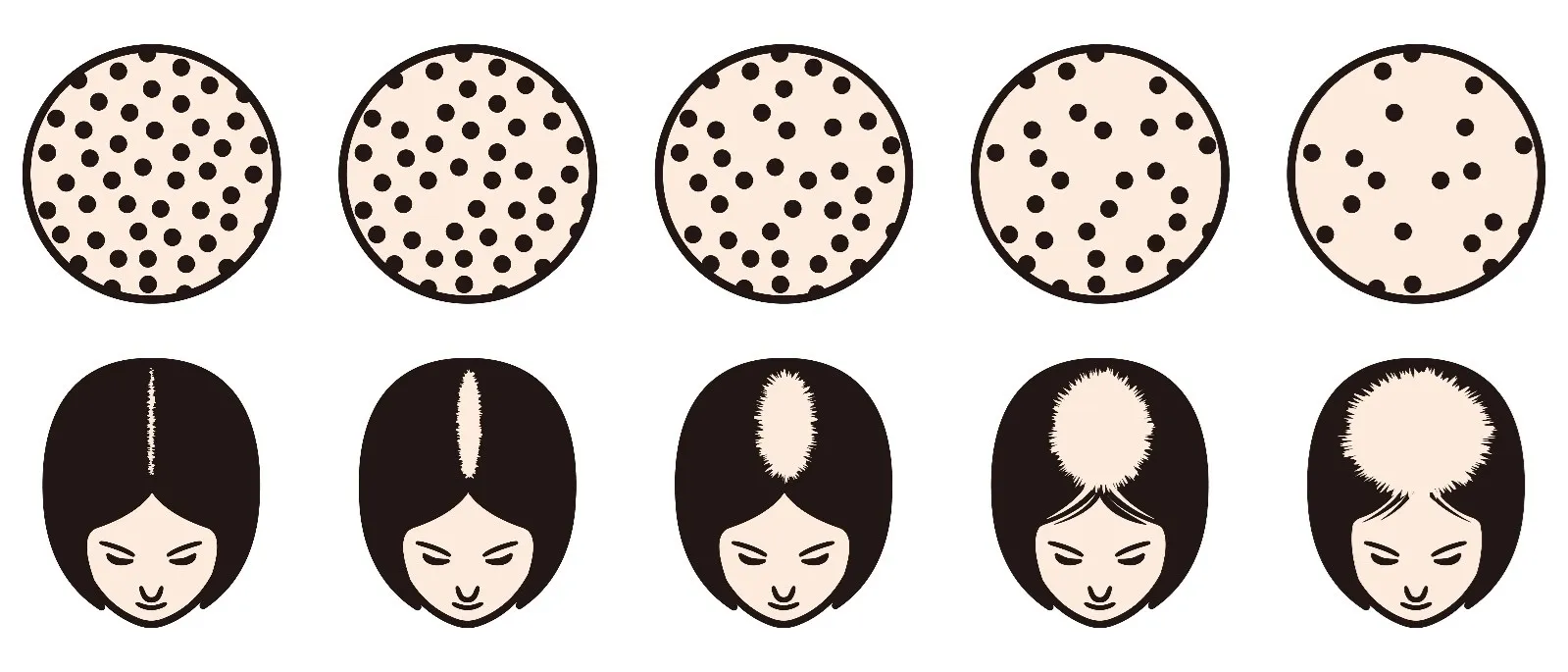 なぜ中高年女性は薄毛になる？更年期と「びまん性脱毛症」