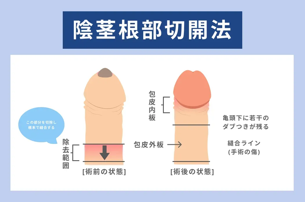 手術の種類と費用相場