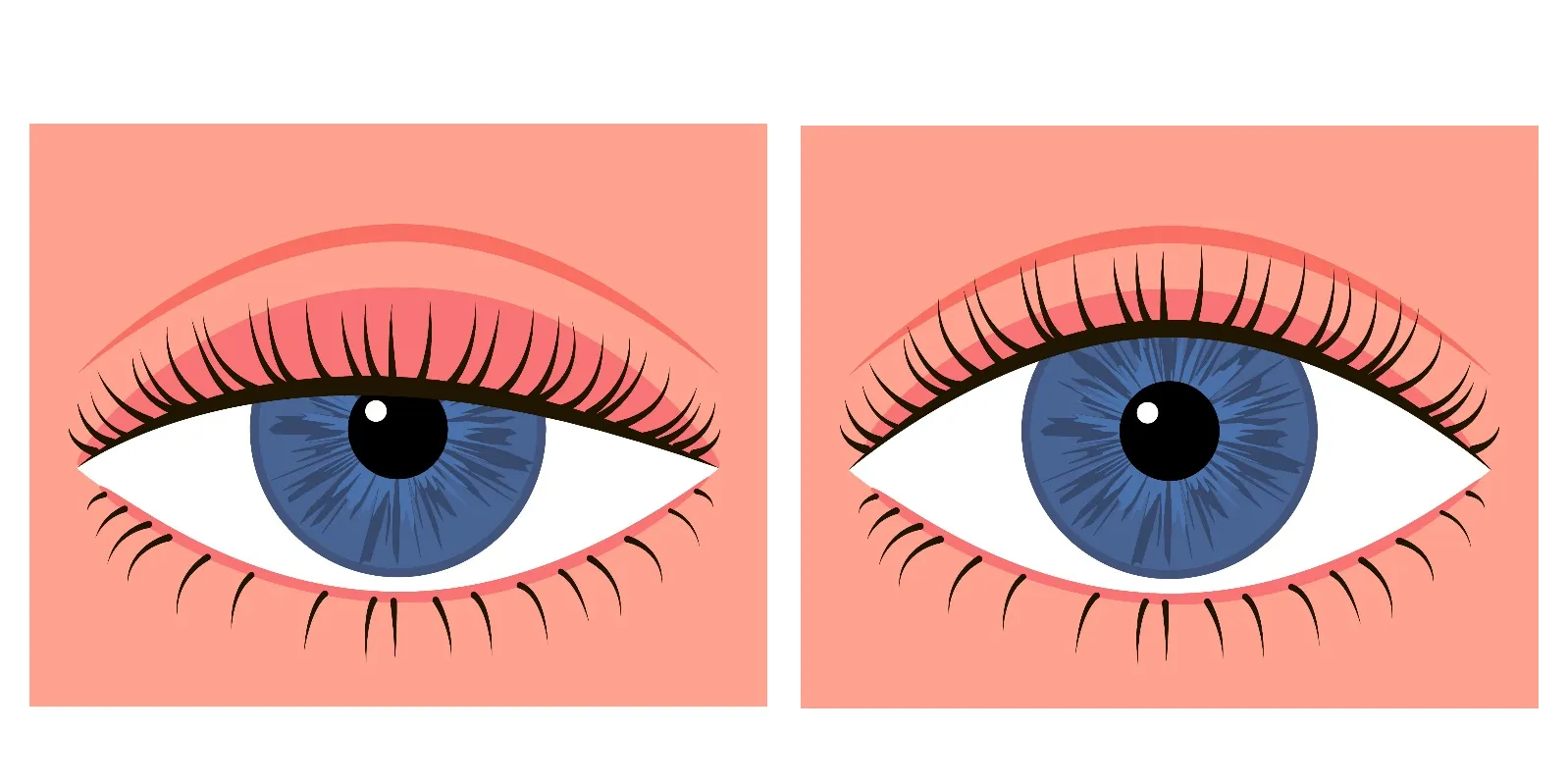 中高年のまぶたの悩み