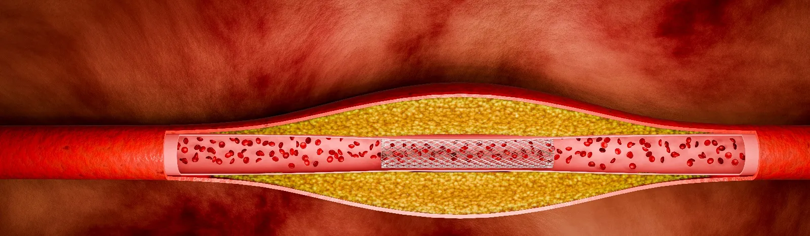 食事でできる脂質異常症予防