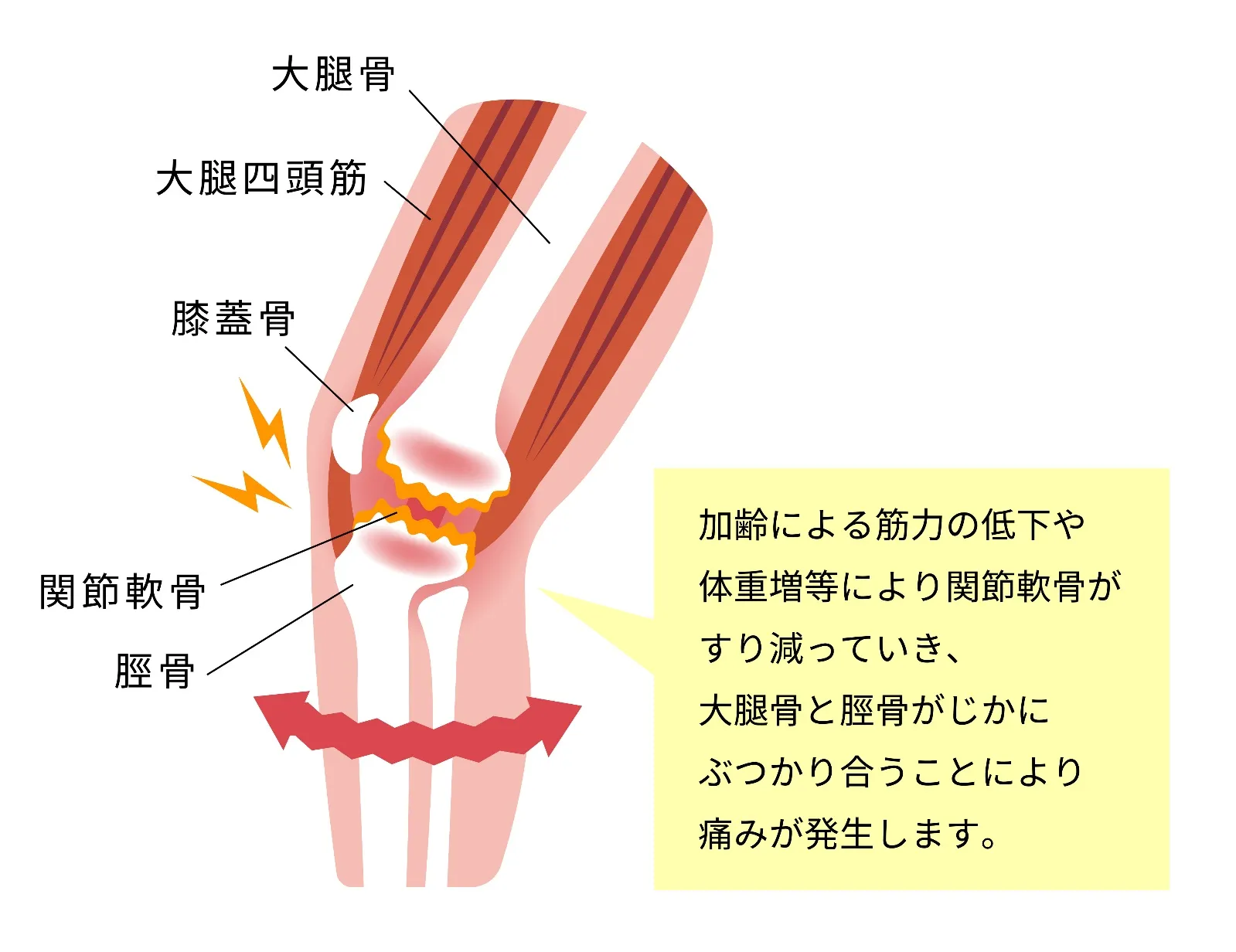 中高年に多い膝の病気と治療法
