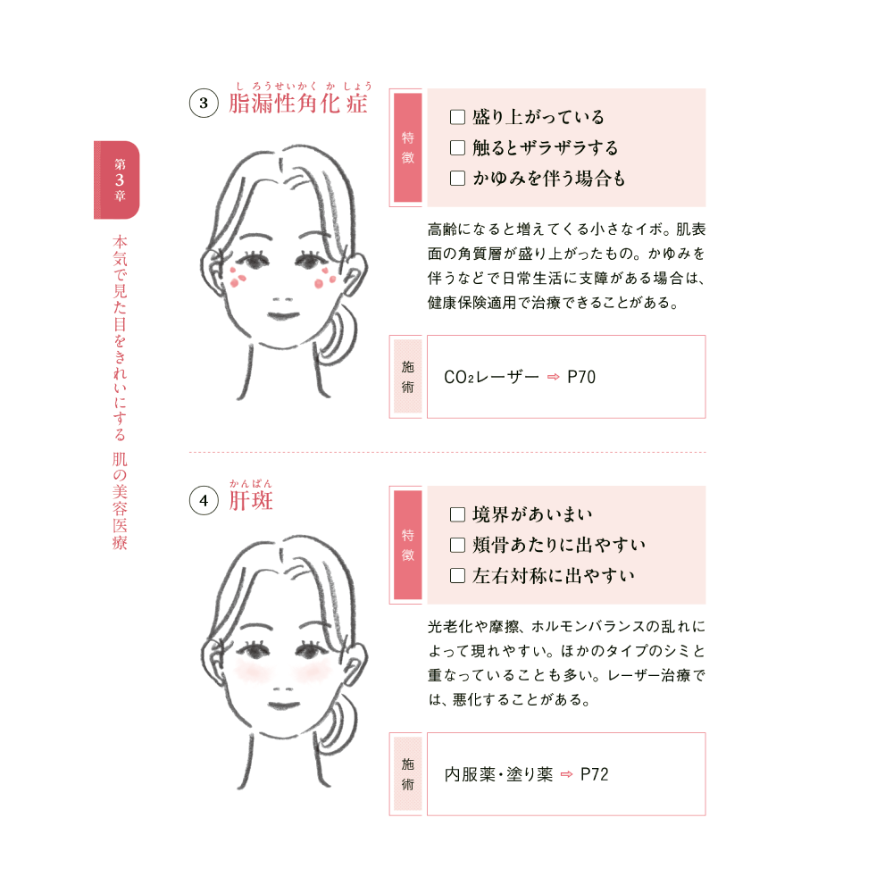 美しさは、再生する。 第3章 本気で見た目をきれいにする 肌の美容医療 シミの主な4つのタイプ