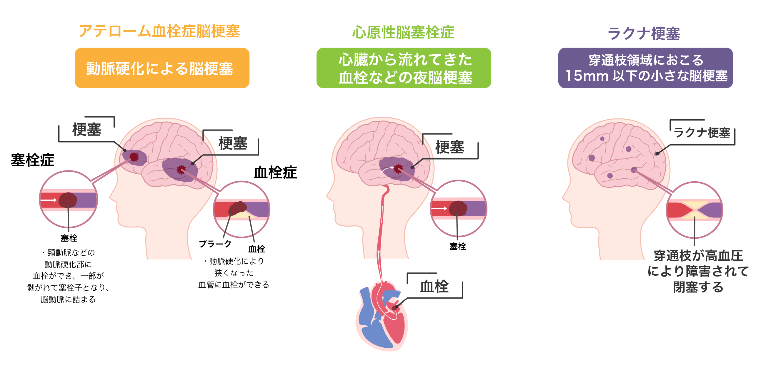 脳梗塞とは