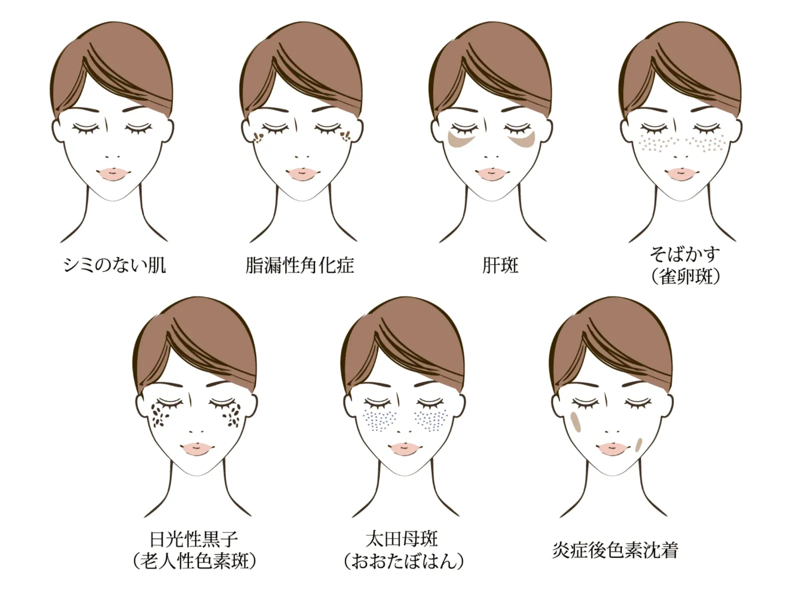 老人性色素斑