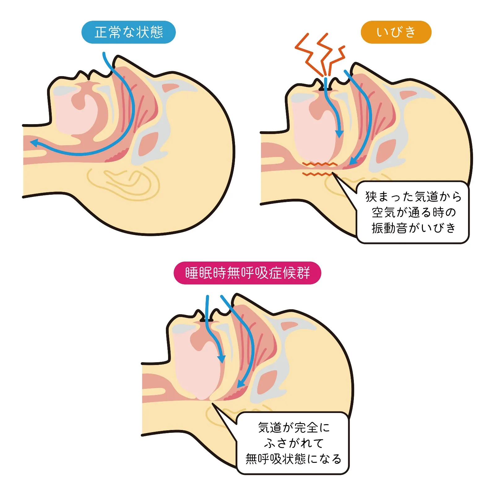 いびきのリスク